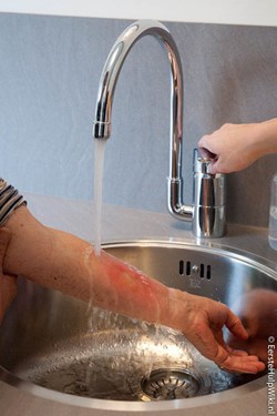 Brandwond behandelen